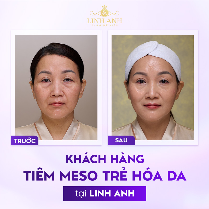 dòng meso nào tốt nhất hiện nay dòng meso nào tốt nhất hiện nay