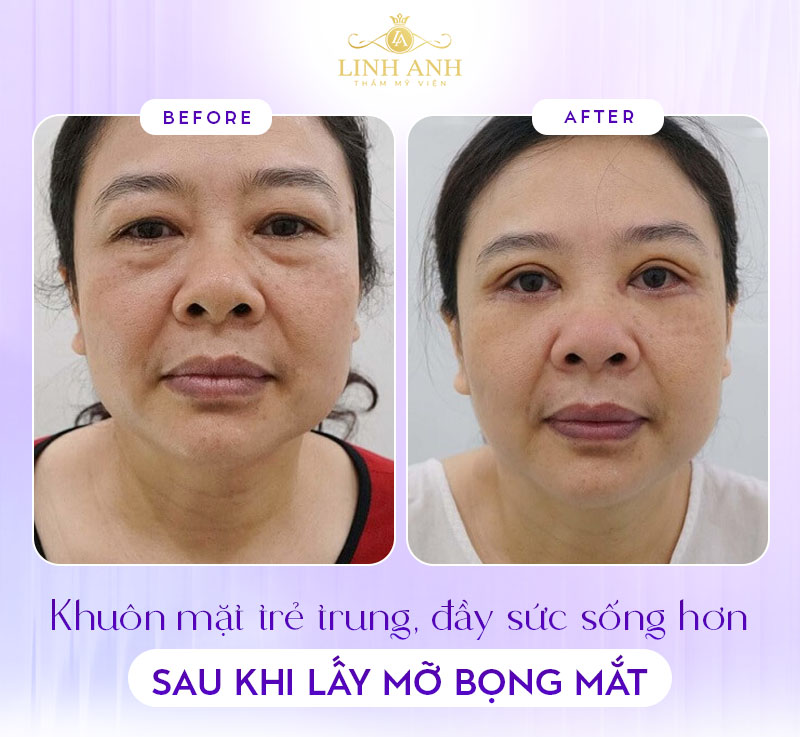 hình ảnh bọng mắt dưới vừa mới cắt xong hình ảnh bọng mắt dưới vừa mới cắt xong