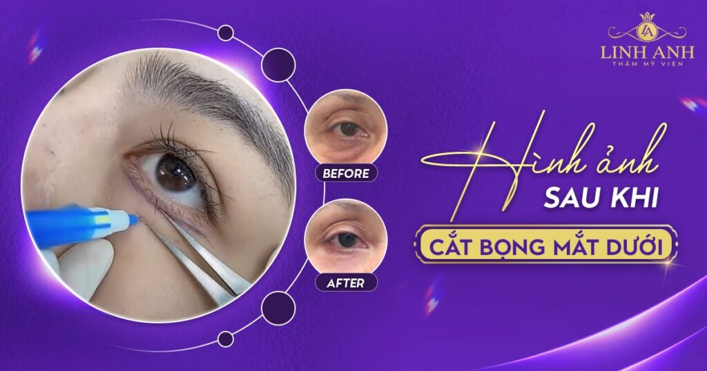 hình ảnh sau khi cắt bọng mắt dưới