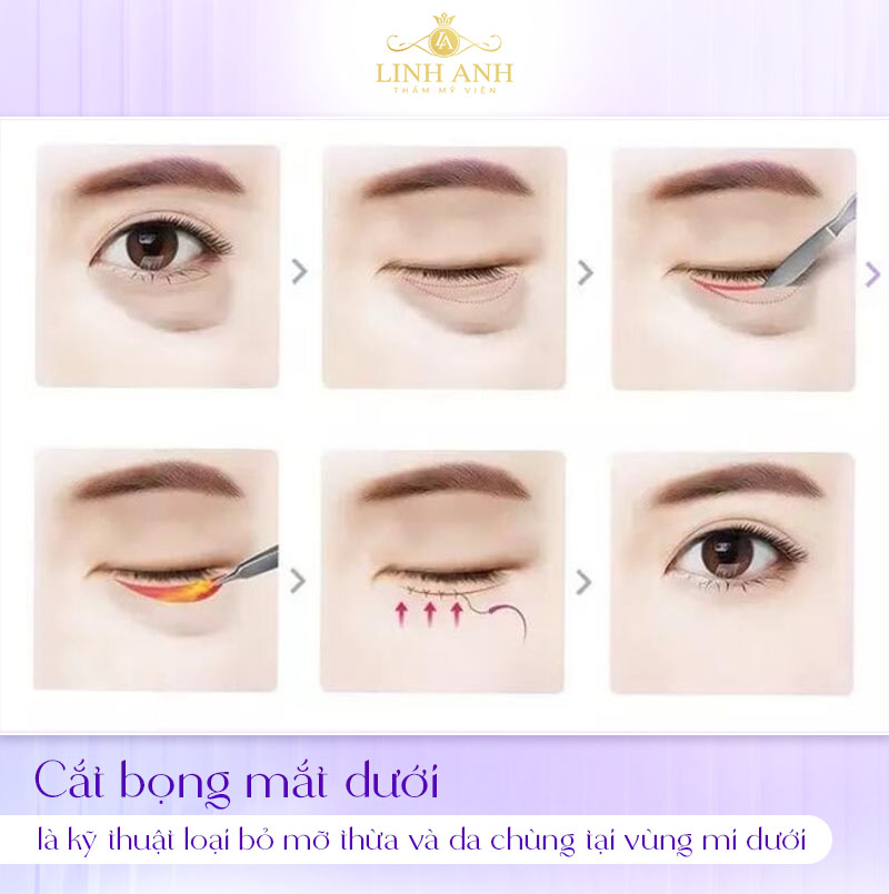 hình ảnh sau khi cắt mỡ bọng mắt dưới hình ảnh sau khi cắt mỡ bọng mắt dưới