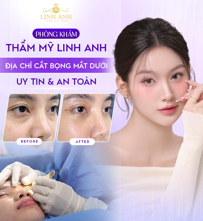 hình ảnh sau khi lấy mỡ bọng mắt dưới hình ảnh sau khi lấy mỡ bọng mắt dưới