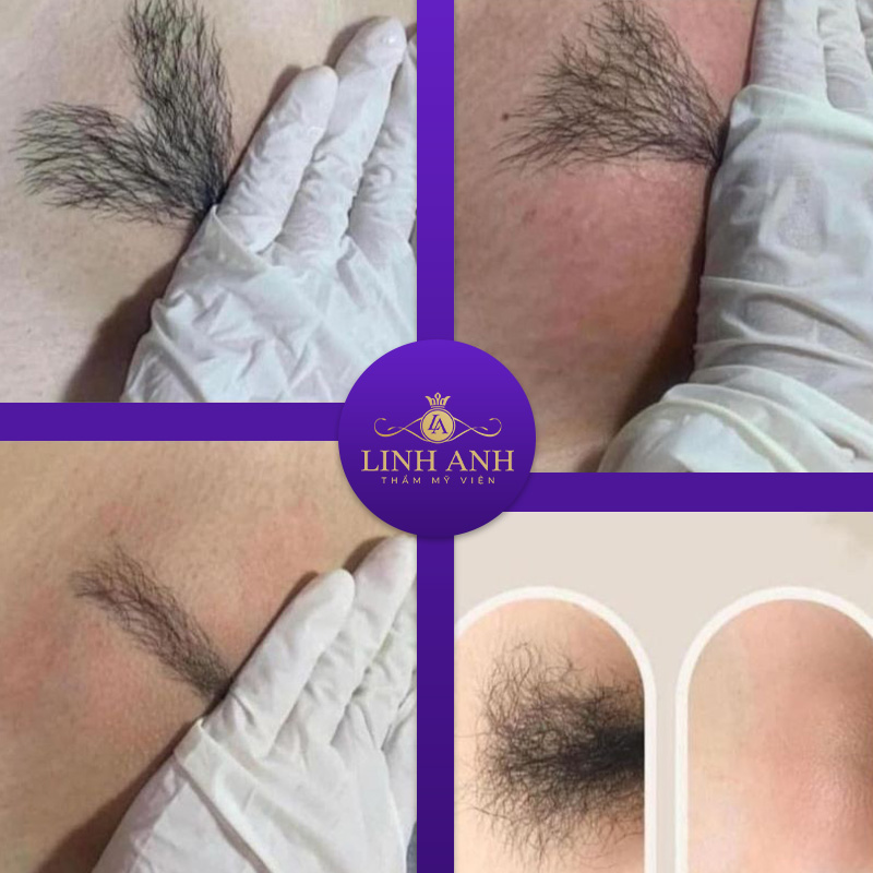 hướng dẫn triệt lông bikini tạo hình giọt nước hướng dẫn triệt lông bikini tạo hình giọt nước