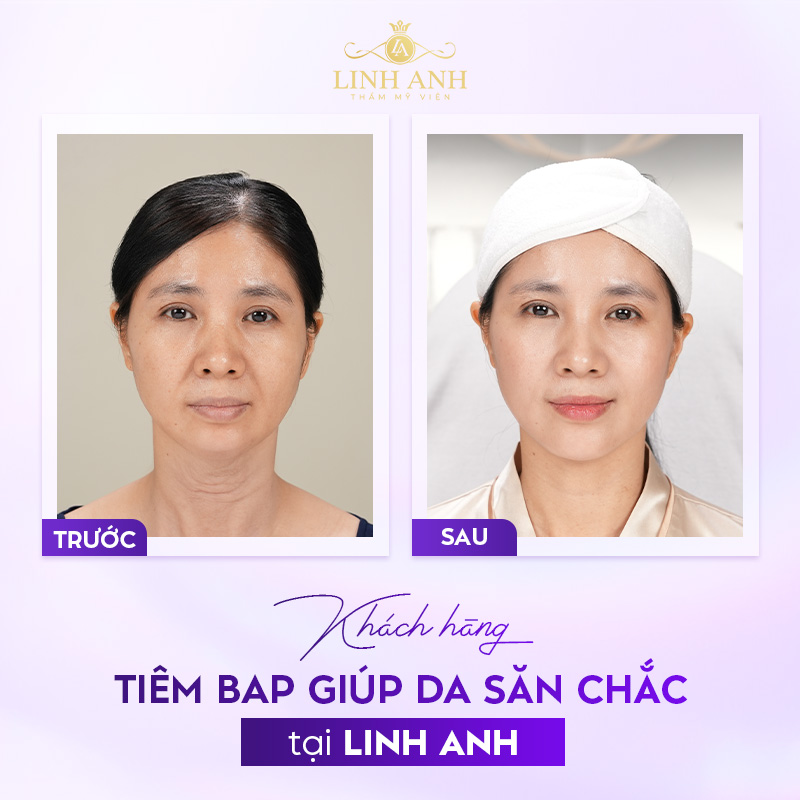 Khách hàng tiêm BAP tại Linh Anh