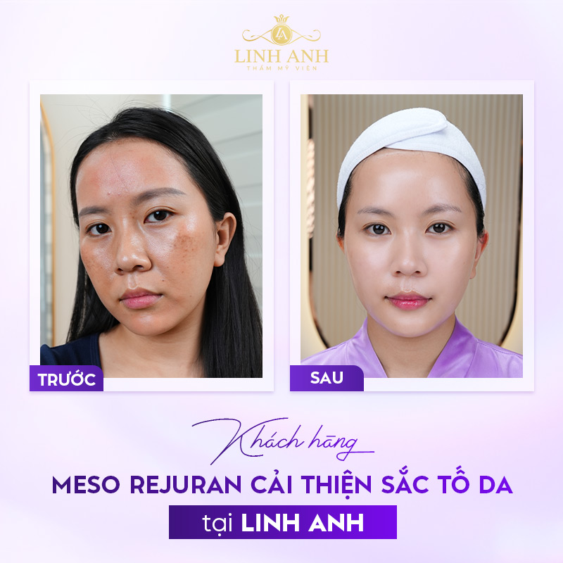 Khách hàng tin chọn tiêm meso Rejuran tại Linh Anh