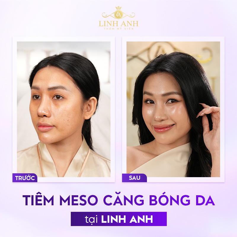 review Meso căng bóng Meso căng bóng