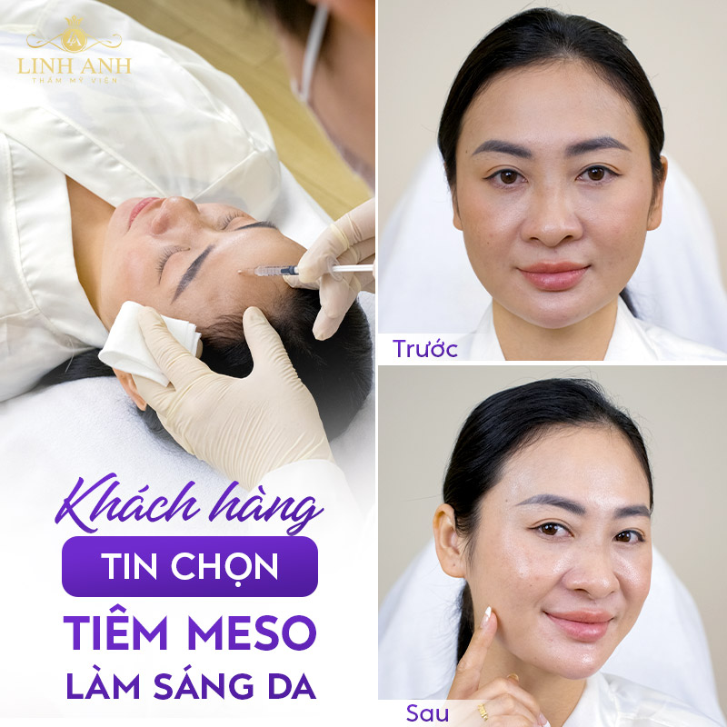 meso oxyx trắng da meso oxyx trắng da