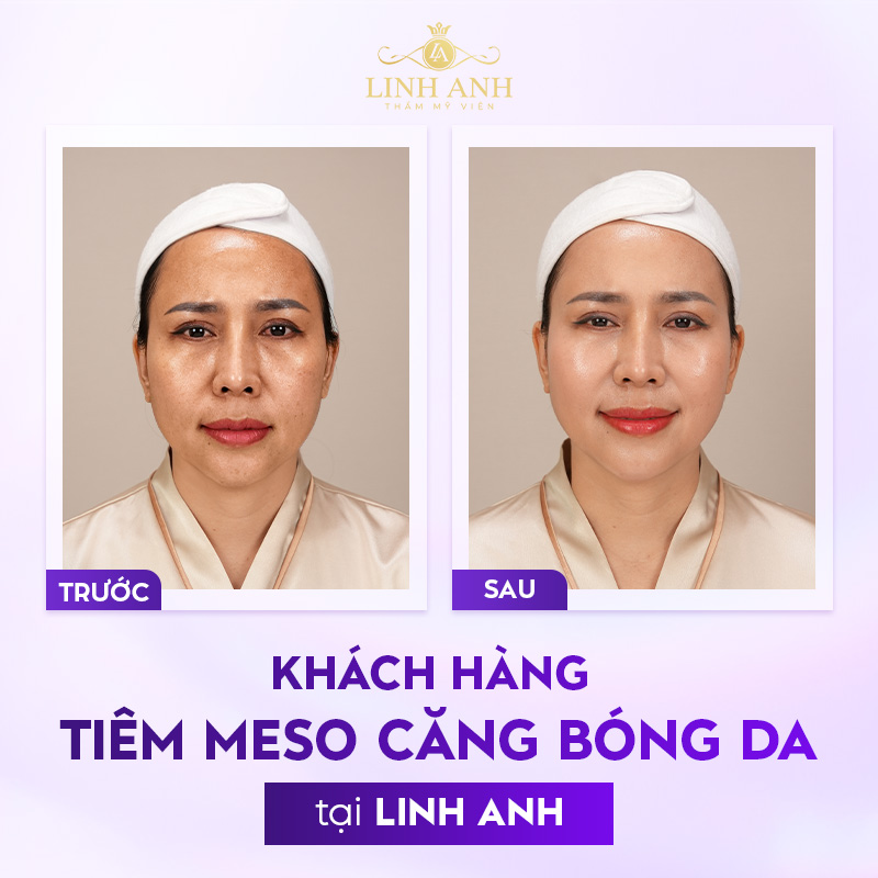 meso tiêm loại nào tốt meso tiêm loại nào tốt