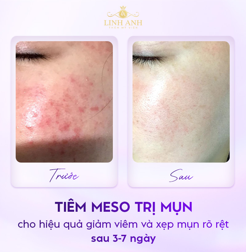 Mesotherapy trị mụn