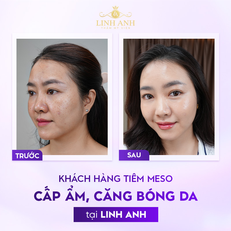 review tiêm meso căng bóng review tiêm meso căng bóng