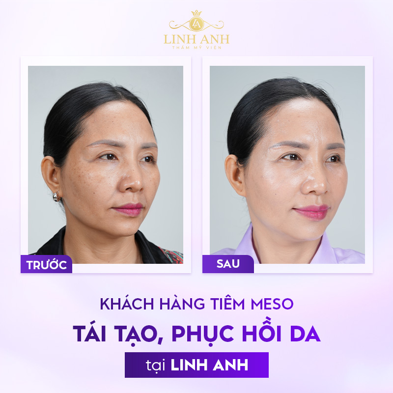 review tiêm meso phục hồi review tiêm meso phục hồi