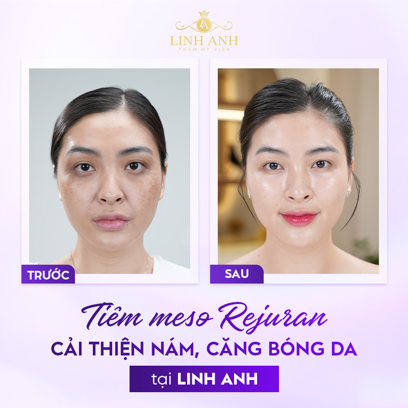 Review Tiêm meso Rejuran Review Tiêm meso Rejuran