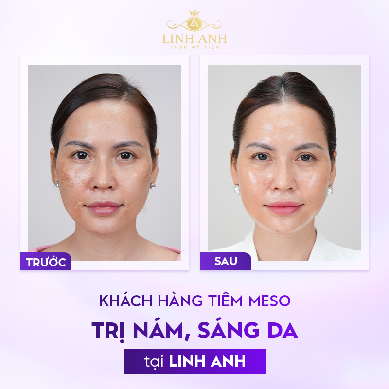 review tiêm meso trị nám review tiêm meso trị nám