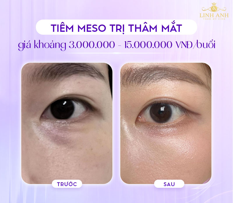 review tiêm meso trị quần thâm mắt review tiêm meso trị quần thâm mắt