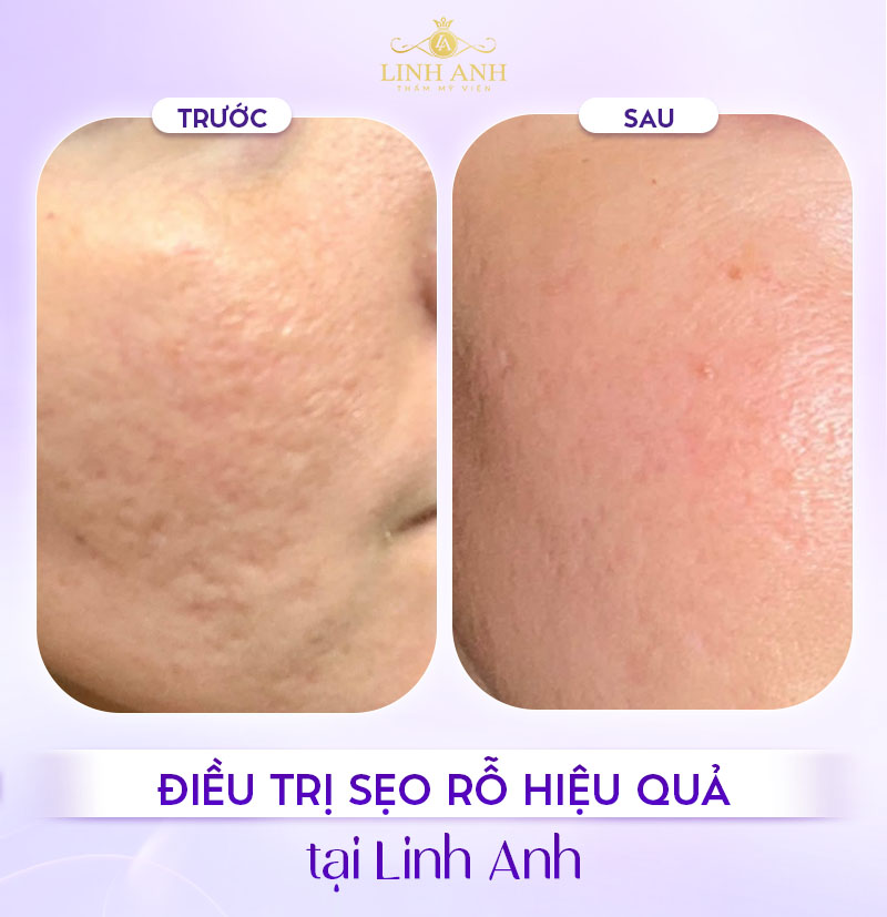 Review Tiêm meso trị sẹo rỗ