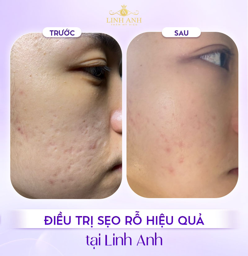 Review Tiêm meso trị sẹo
