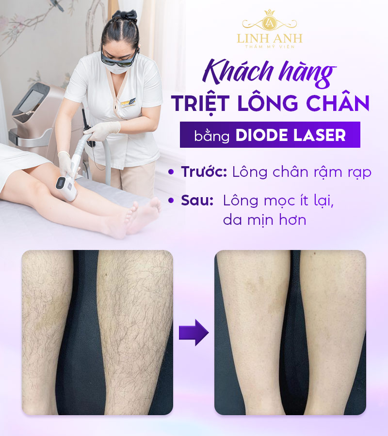 sản phẩm triệt lông Nhật Bản phổ biến sản phẩm triệt lông Nhật Bản phổ biến