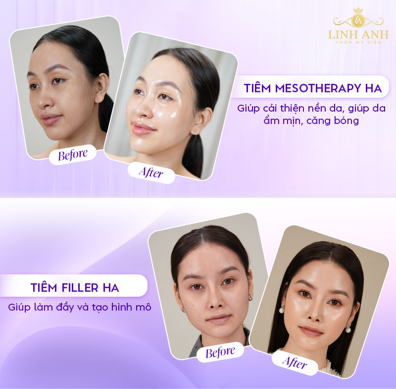 Tiêm HA trong mesotherapy khác gì HA trong filler? Tiêm HA trong mesotherapy khác gì HA trong filler?