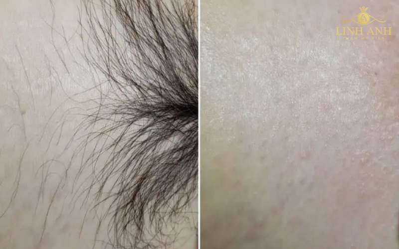 tạo hình giọt nước khi triệt lông bikini tạo hình giọt nước khi triệt lông bikini