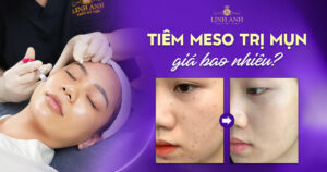 Tiêm meso trị mụn