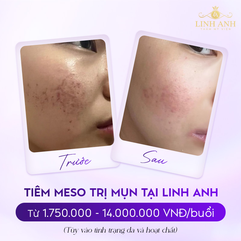 Tiêm meso trị mụn giá bao nhiêu Tiêm meso trị mụn giá bao nhiêu