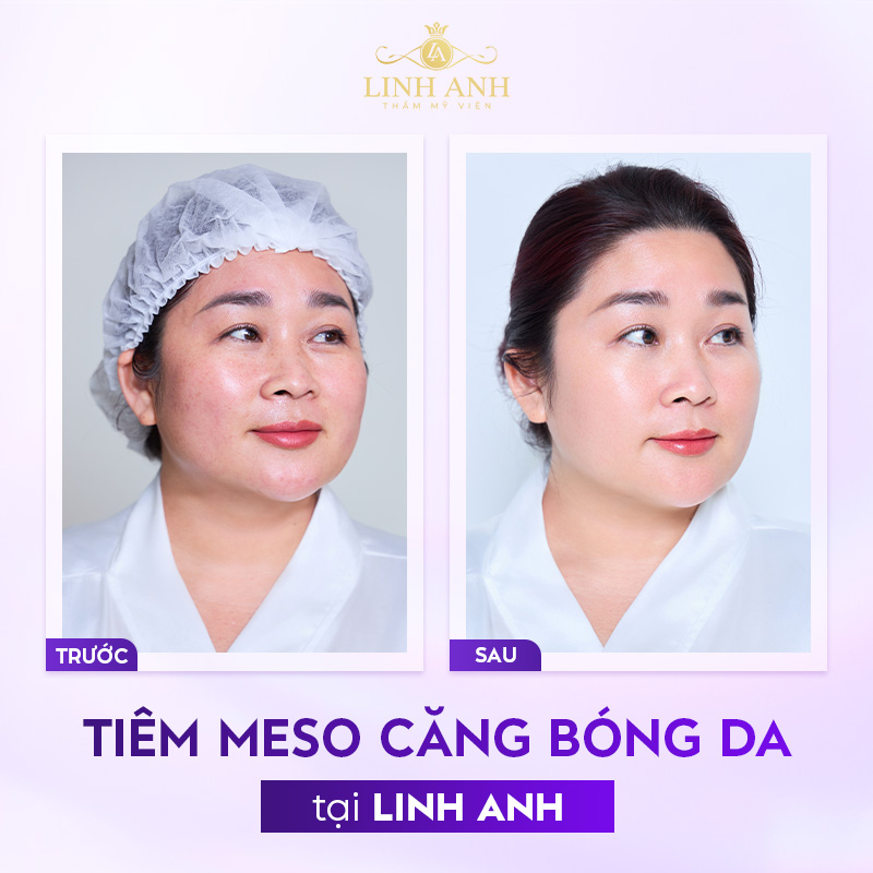 Tiêm căng bóng da meso Tiêm căng bóng da meso
