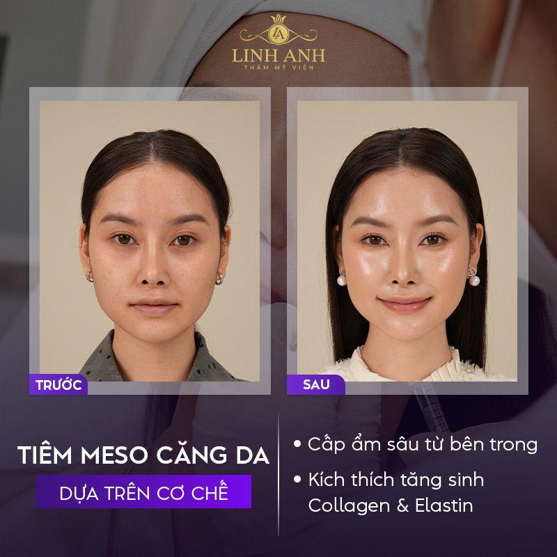 Tiêm meso căng bóng Tiêm meso căng bóng