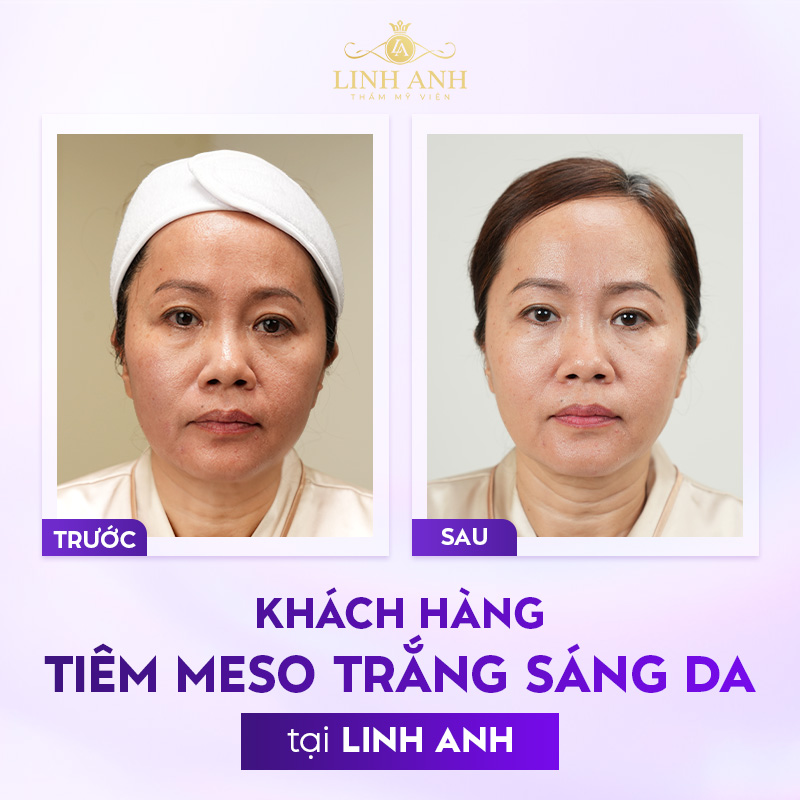 meso tiêm dòng nào tốt meso tiêm dòng nào tốt