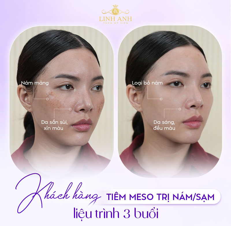 tiêm meso exocode tiêm meso exocode