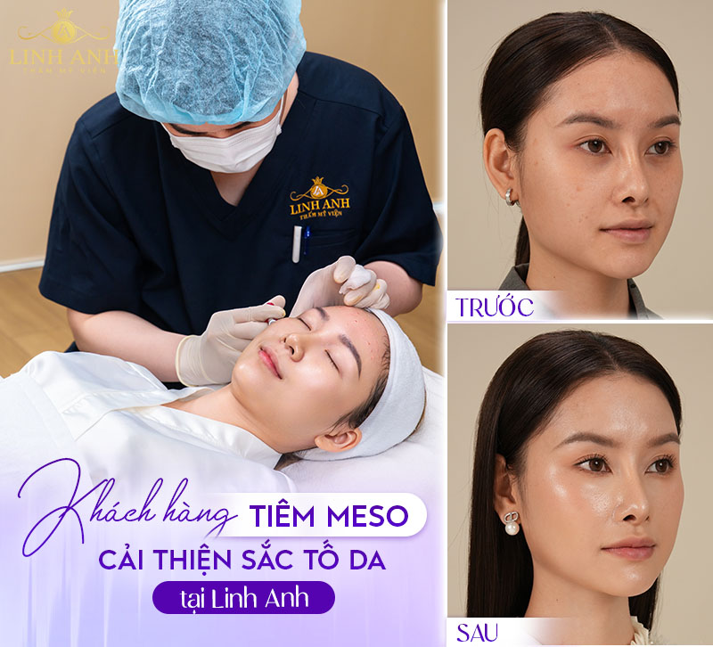 review Tiêm Meso Tiêm Meso Fetoscell