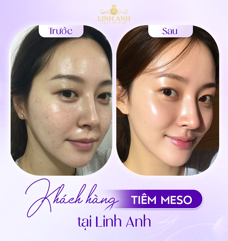 Tiêm meso không đau tại Linh Anh