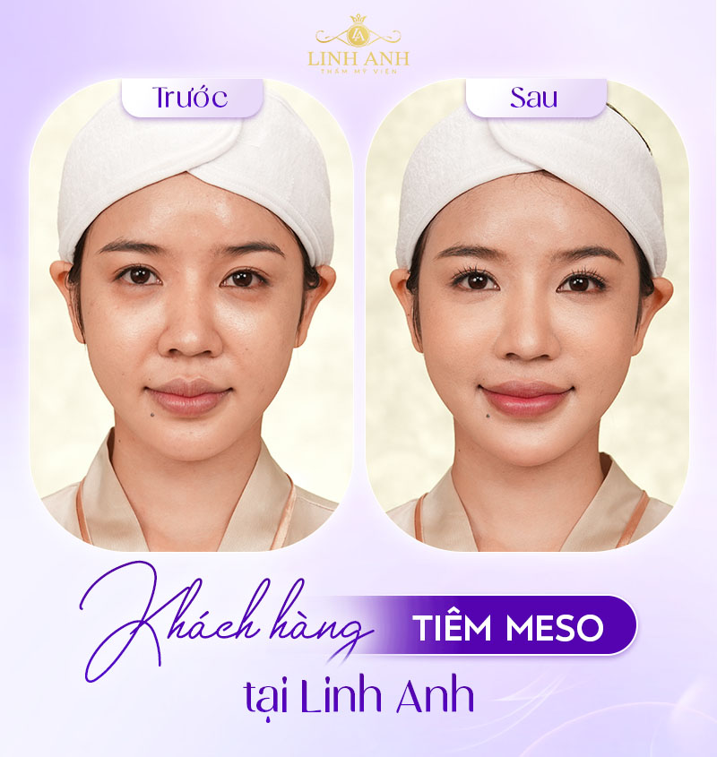 tiêm meso không đau tại phòng khám thẩm mỹ Linh Anh