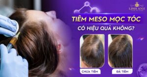 Tiêm meso mọc tóc