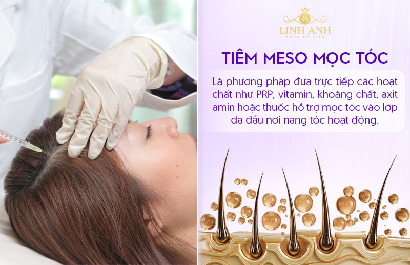 Tiêm meso mọc tóc có hiệu quả không Tiêm meso mọc tóc có hiệu quả không