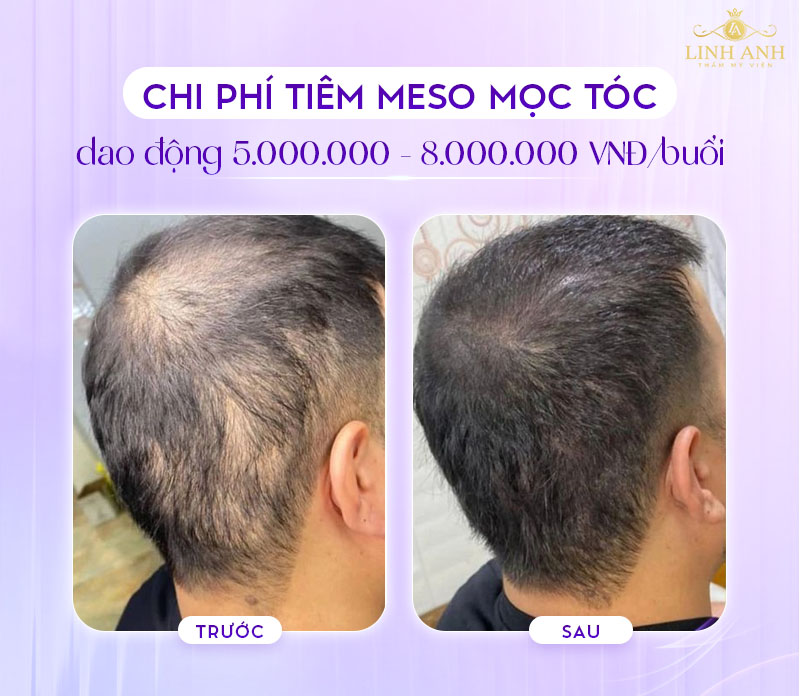 Tiêm meso mọc tóc giá bao nhiêu Tiêm meso mọc tóc giá bao nhiêu
