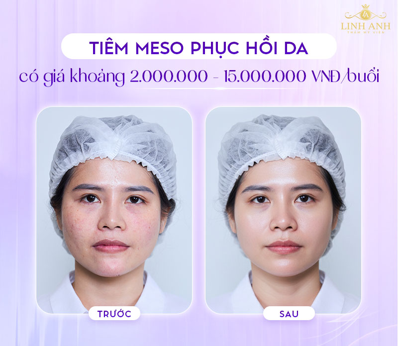 tiêm meso phục hồi da bao nhiêu tiền tiêm meso phục hồi da bao nhiêu tiền