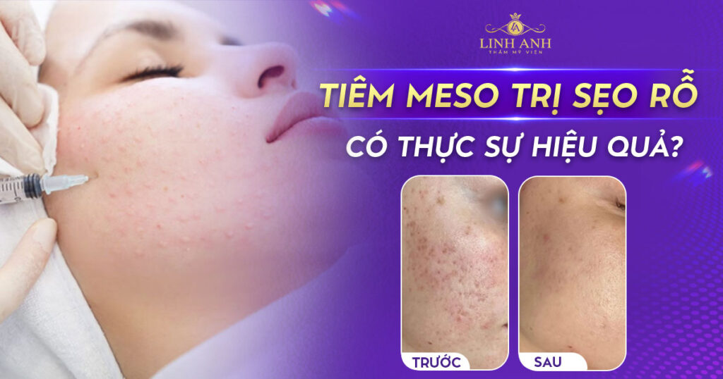 Tiêm meso trị sẹo rỗ
