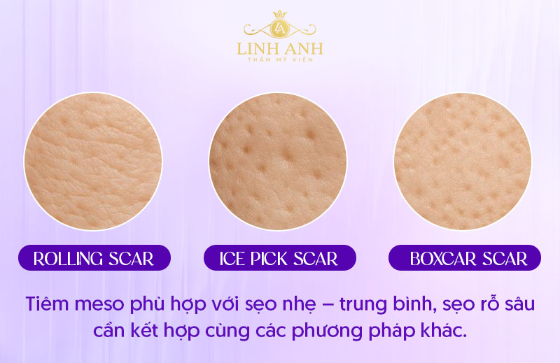 Tiêm meso trị sẹo rỗ bao lâu thấy hiệu quả?