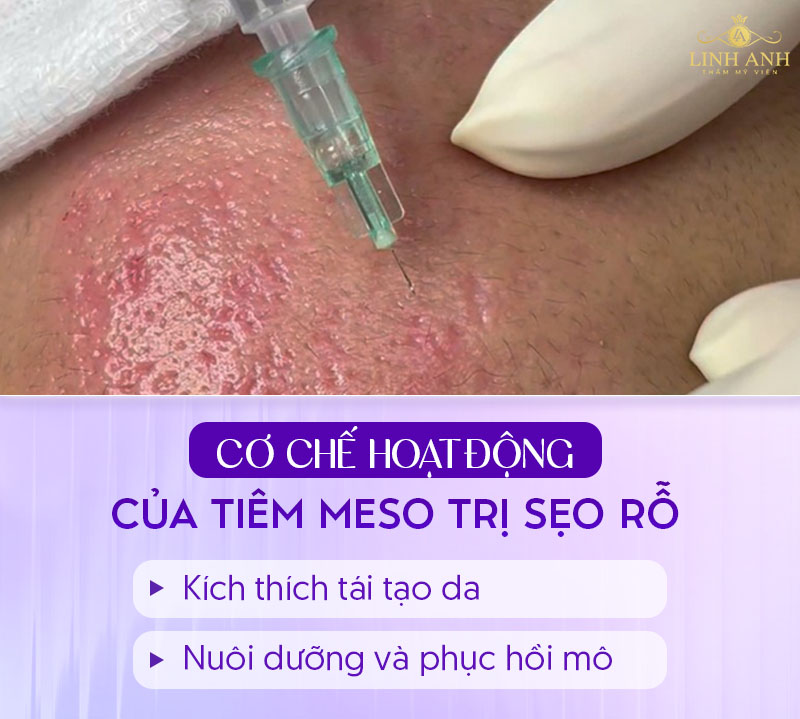 Tiêm meso trị sẹo rỗ được không