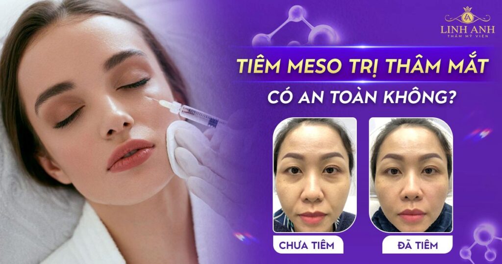 tiêm meso trị thâm mắt