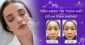 tiêm meso trị thâm mắt