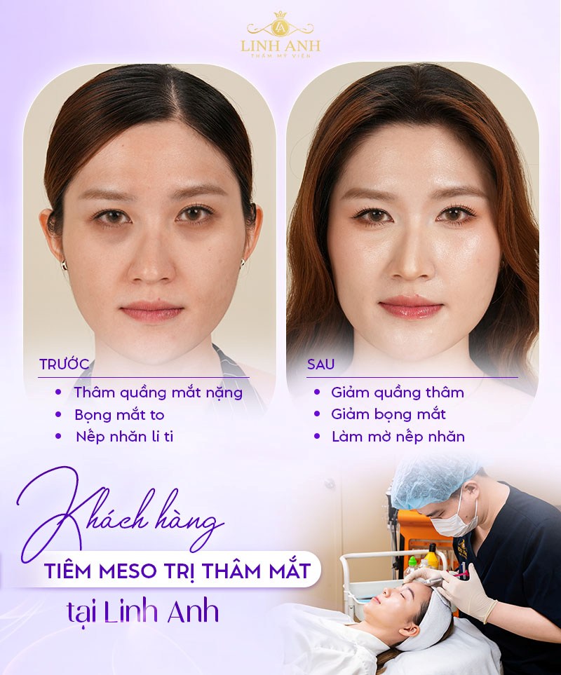 tiêm meso trị thâm quần mắt tiêm meso trị thâm quần mắt