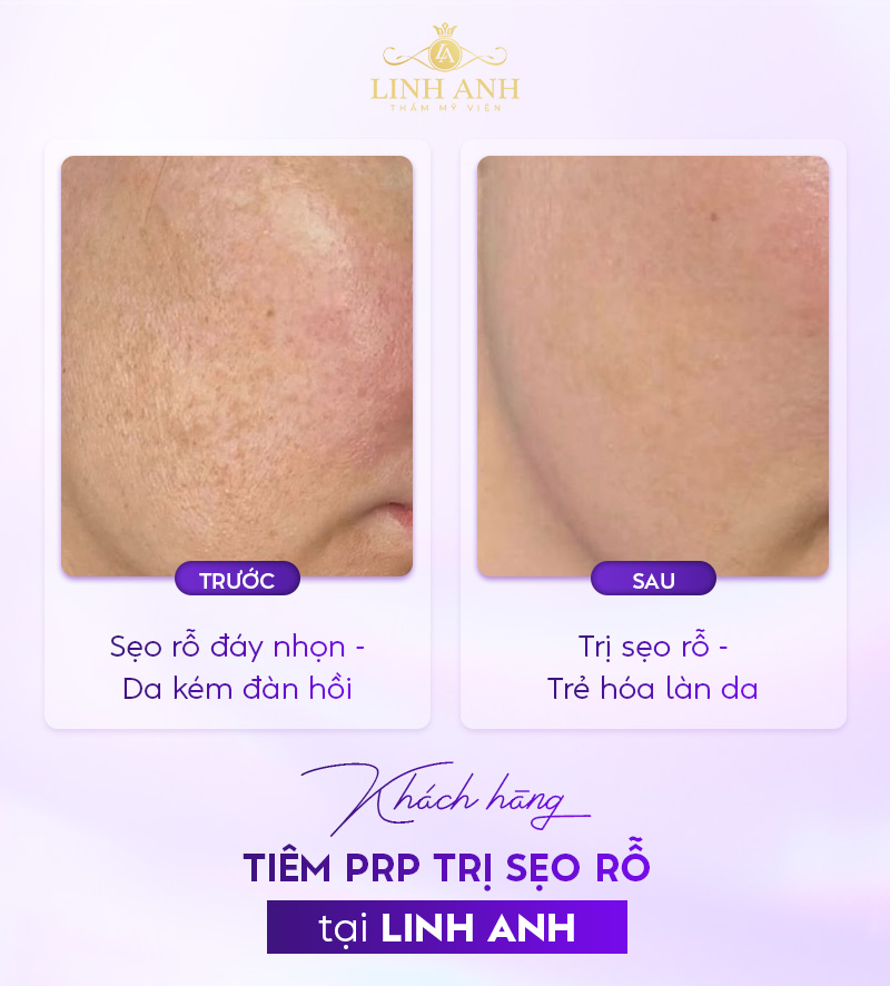 Tiêm PRP trị sẹo rỗ Tiêm PRP trị sẹo rỗ tại Phòng khám thẩm mỹ Linh Anh