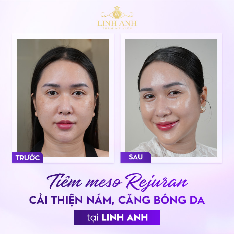 Tiêm Rejuran trước và sau Tiêm Rejuran trước và sau