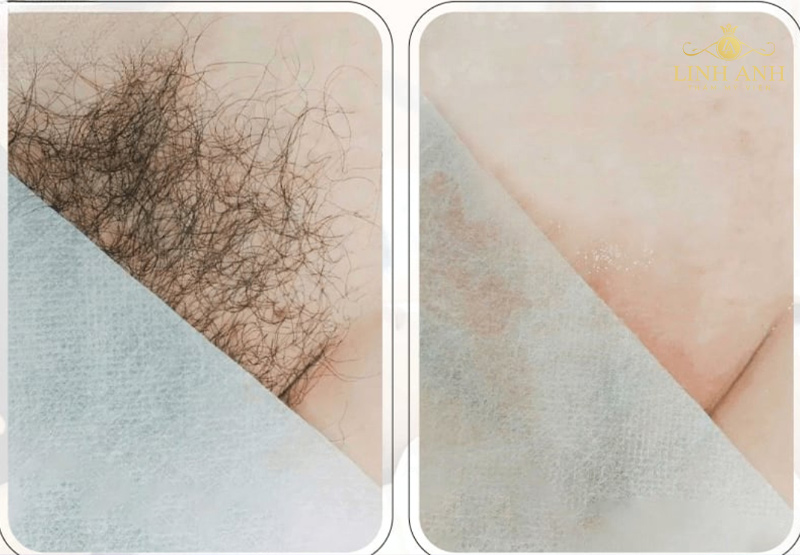 triệt lông vùng kín tạo hình giọt nước triệt lông vùng kín tạo hình giọt nước