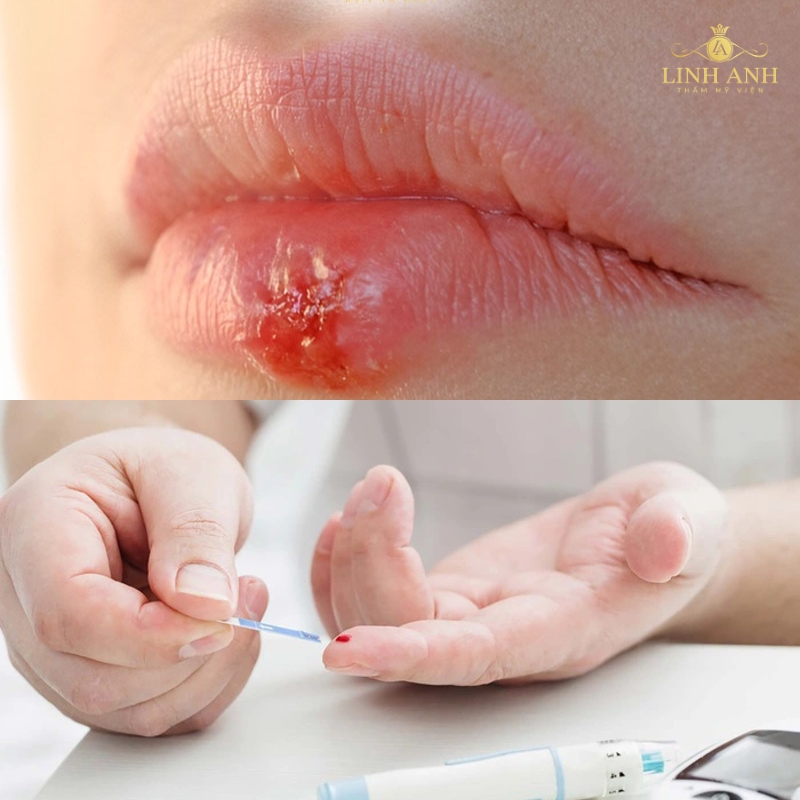 Bị đái tháo đường phun xăm thẩm mỹ lâu lành