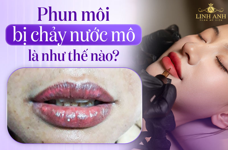 Xăm môi bị chảy nước mô vàng
