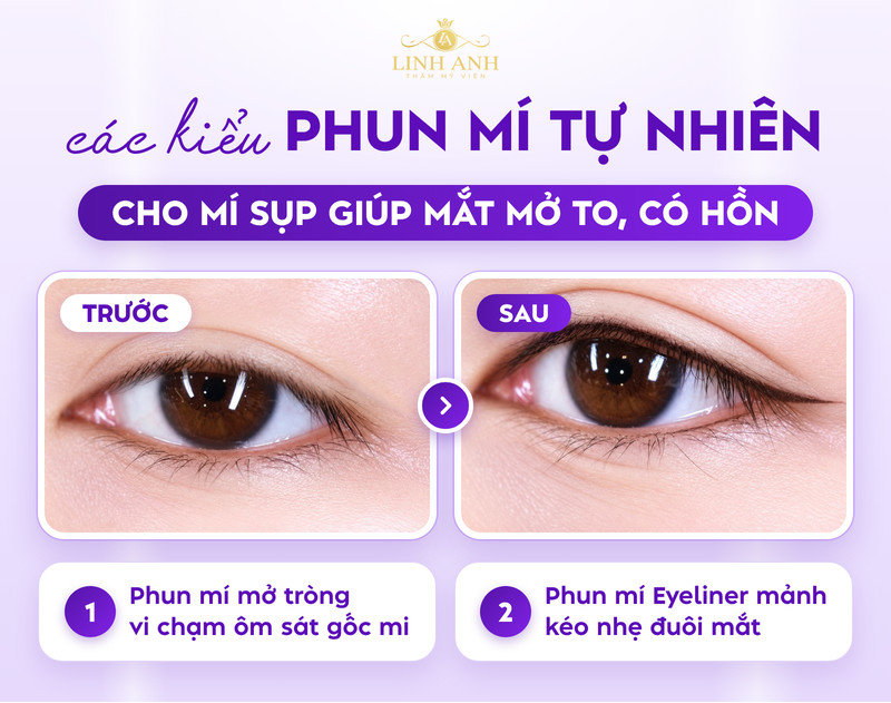 Mí sụp có nên phun mí không? Phương pháp cải thiện HIỆU QUẢ 20 Phun mí tự nhiên cho mí sụp