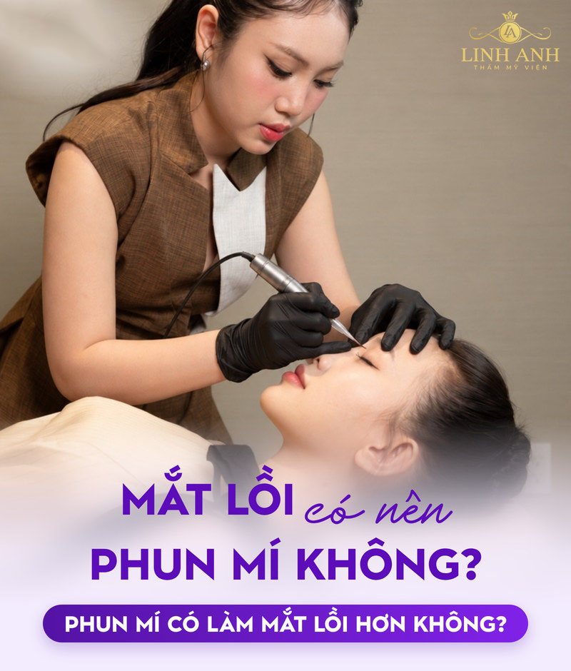 Mắt lồi có nên phun mí không? Cần lưu ý điều gì? 18 Mắt lồi nên phun mí