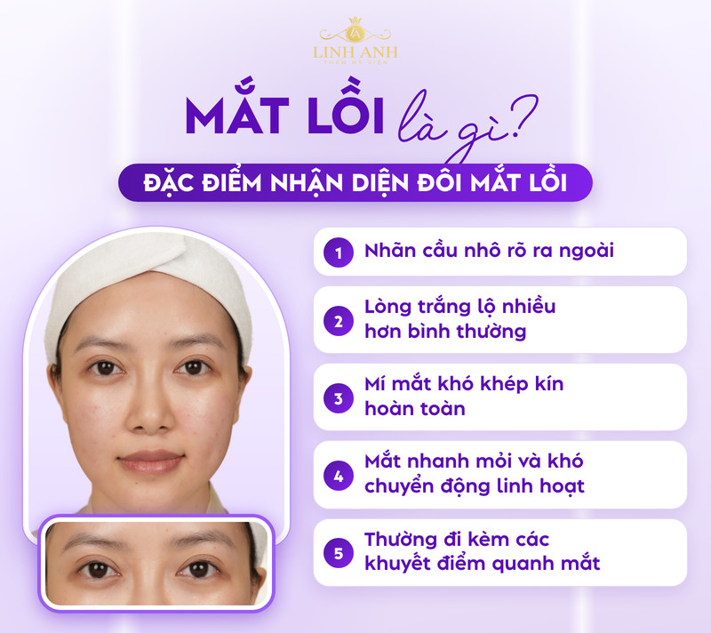 Mắt lồi có nên phun mí không? Cần lưu ý điều gì? 17 Mắt lồi nhãn cầu nhô rõ