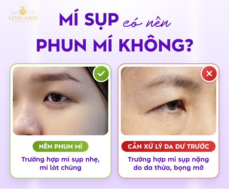 Mí sụp có nên phun mí không? Phương pháp cải thiện HIỆU QUẢ 17 Mí sụp nên phun mí